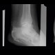 Calcar calcanei, calcifications in plantar aponeurosis, spur: X-ray - Plain radiograph